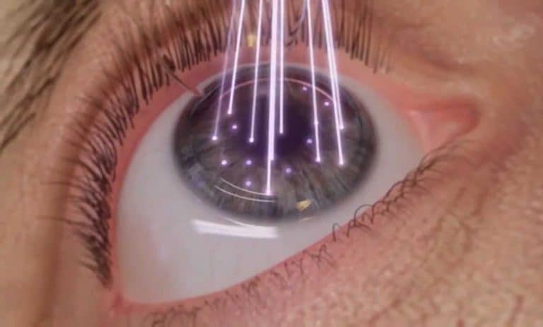 Chirurgie Oculaire Au Laser En Quoi Consiste T Elle